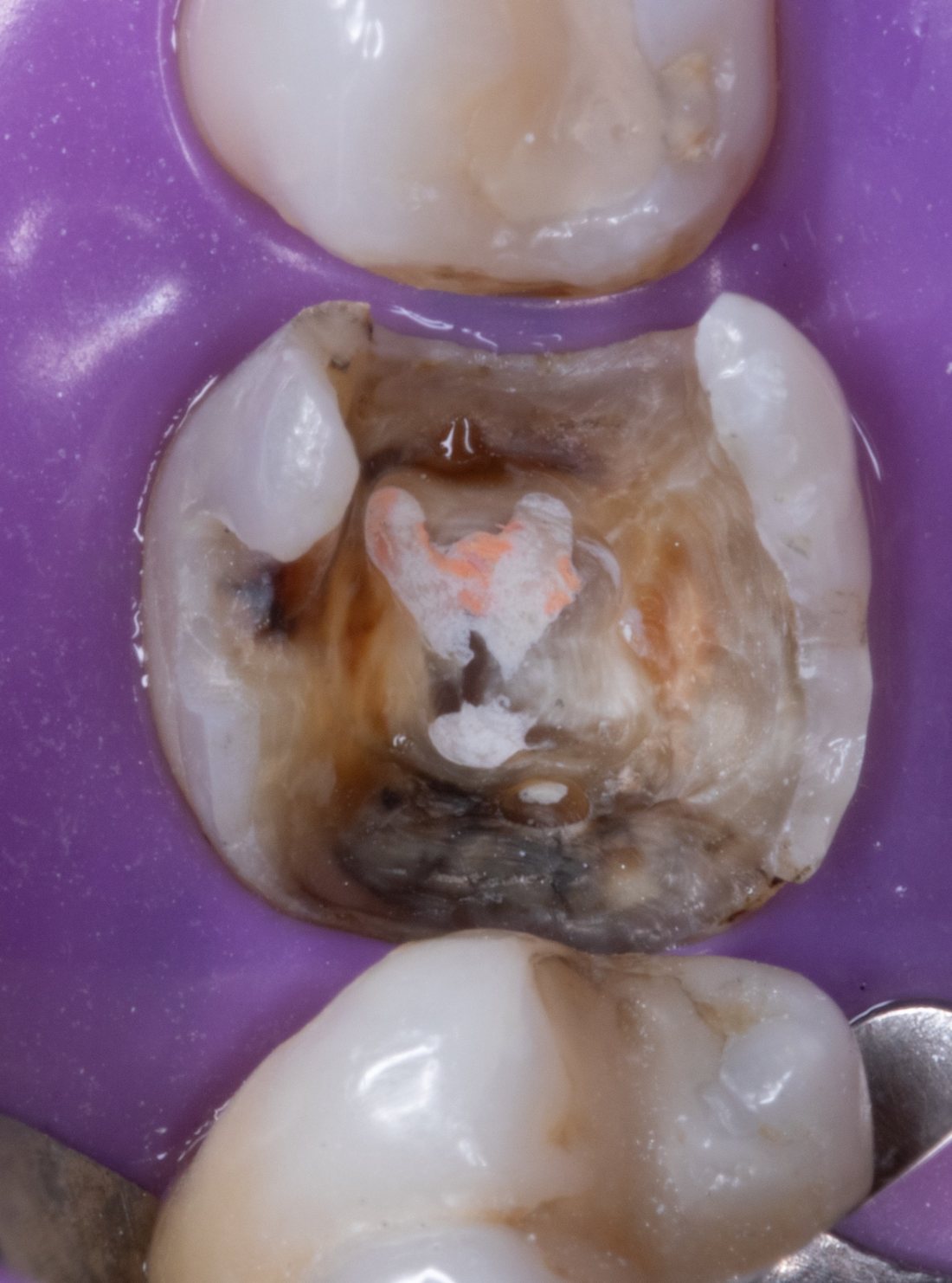 Cúspides fragilizadas com espessura mínima e trinca em cavidade profunda